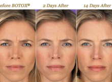 botox-treatment
