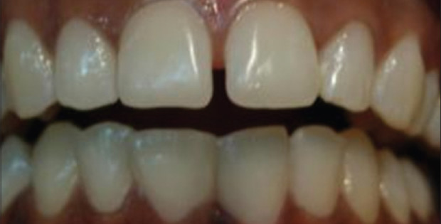 midline-diastema