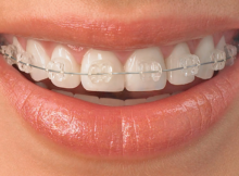 braces-dental