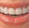 braces-dental
