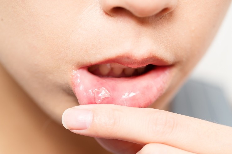 Mouth Ulcer