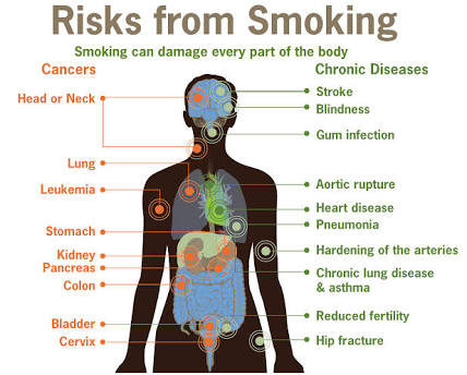 Passive Smoking