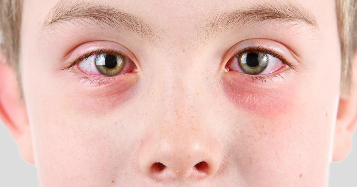 pink-eye