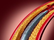coronary stents
