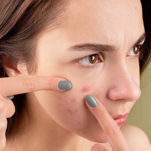 pimples remedy