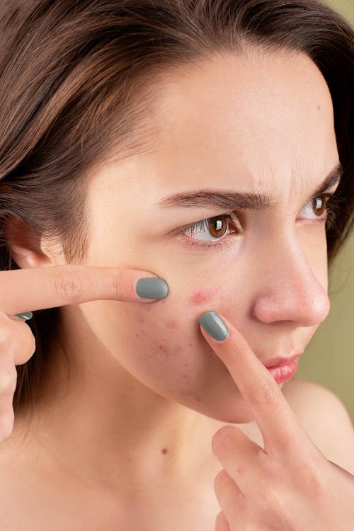 pimples remedy